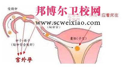 護士資格考試之宮外孕考點內(nèi)容