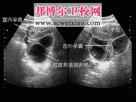 異位妊娠的身體狀況是怎樣的