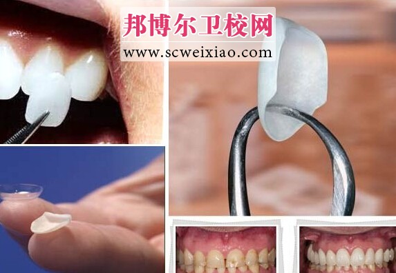 瓷貼面優(yōu)缺點(diǎn)整理