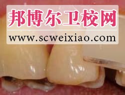 窩洞預(yù)備的五個基本步驟