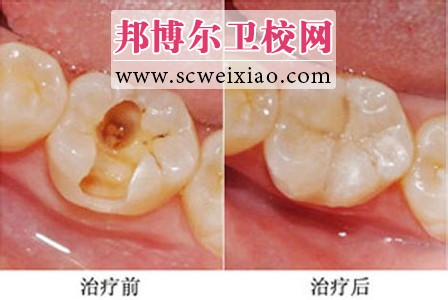 窩洞的命名與分類