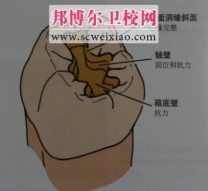窩洞的結構