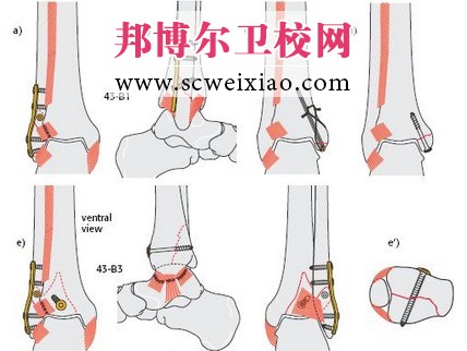 骨折愈合期從哪些方面進(jìn)行康復(fù)治療