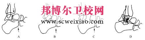 骨折固定期從哪些方面進行康復護理
