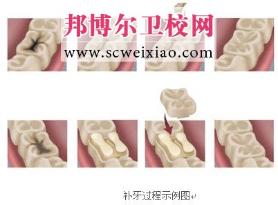 哪些情況下需要補牙