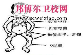 維生素D缺乏時(shí)如何治療及早期預(yù)防